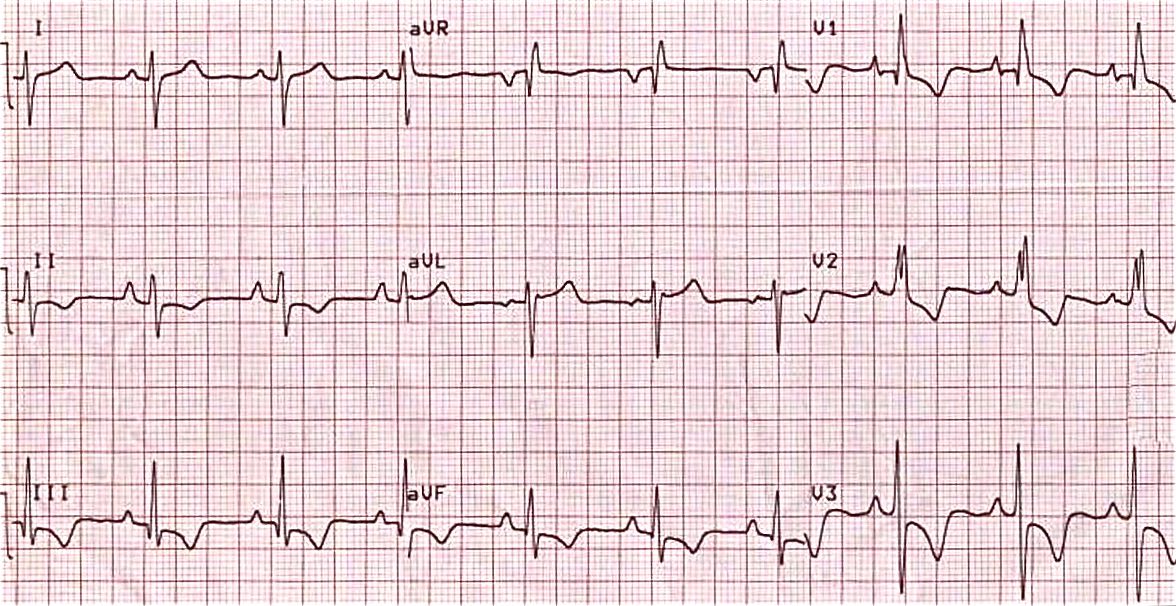 آموزش نوار قلب (ECG) بخش چهل و یکم وب سایت دکتر مجری